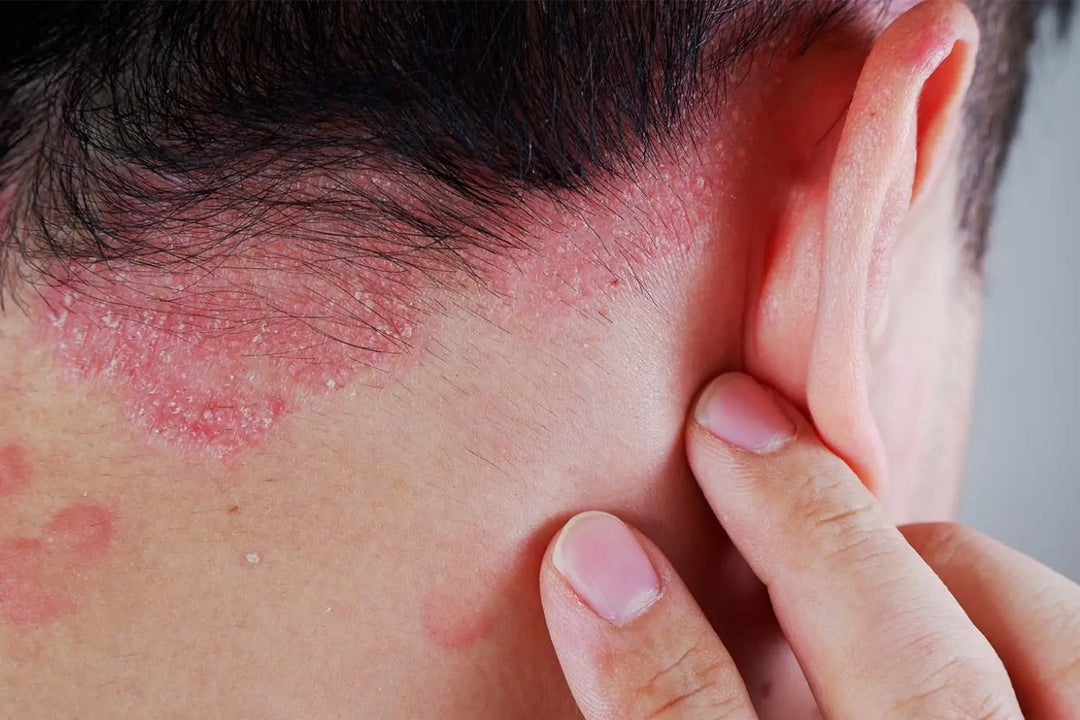 Supplements for Psoriasis